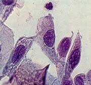 Mäßige Zellveränderung Grad III D