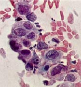 Schwere Zellveränderung Grad V (Karzinom)